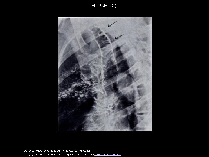 FIGURE 1(C) Dis Chest 1966 49345 -351 DOI: (10. 1378/chest. 49. 4. 345) Copyright
