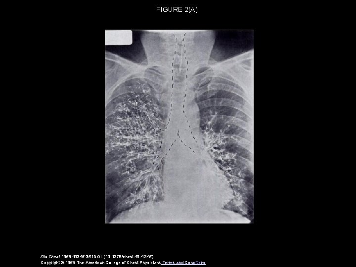 FIGURE 2(A) Dis Chest 1966 49345 -351 DOI: (10. 1378/chest. 49. 4. 345) Copyright