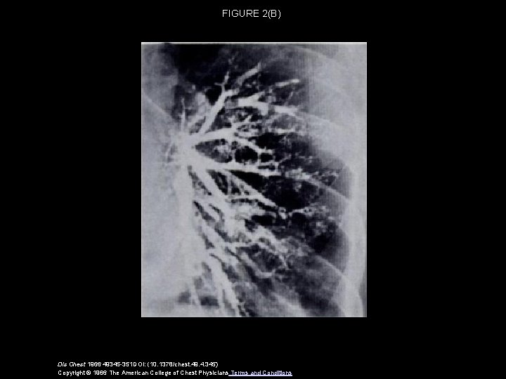 FIGURE 2(B) Dis Chest 1966 49345 -351 DOI: (10. 1378/chest. 49. 4. 345) Copyright