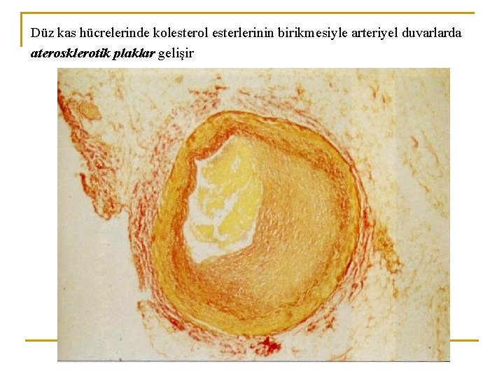 Düz kas hücrelerinde kolesterol esterlerinin birikmesiyle arteriyel duvarlarda aterosklerotik plaklar gelişir 