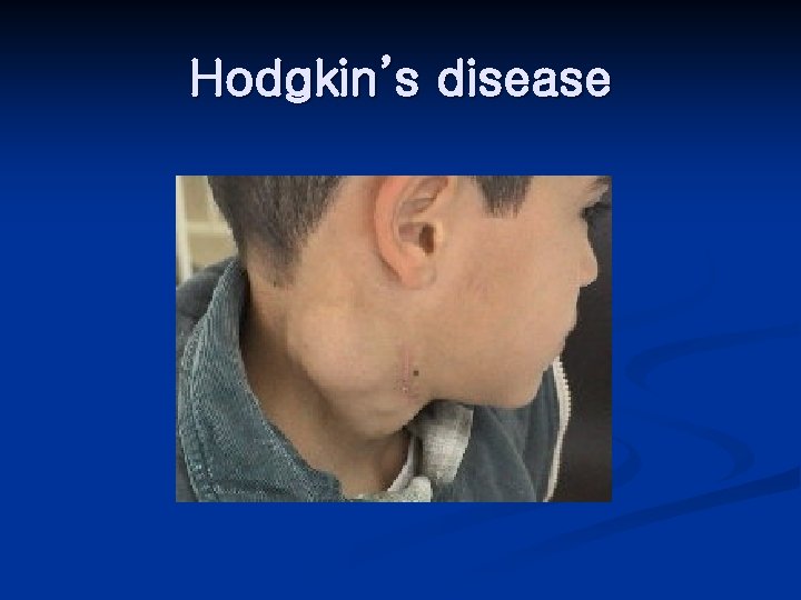 Hodgkin’s disease 