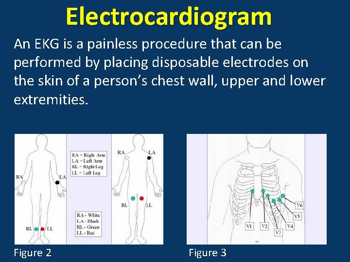Electrocardiogram An EKG is a painless procedure that can be performed by placing disposable