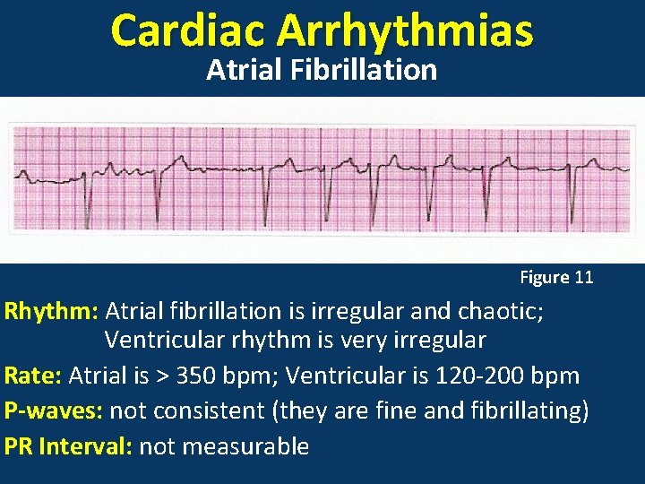 Cardiac Arrhythmias Atrial Fibrillation Figure 11 Rhythm: Atrial fibrillation is irregular and chaotic; Ventricular