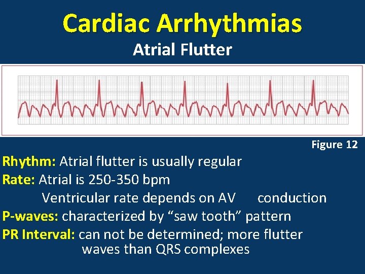 Cardiac Arrhythmias Atrial Flutter Figure 12 Rhythm: Atrial flutter is usually regular Rate: Atrial