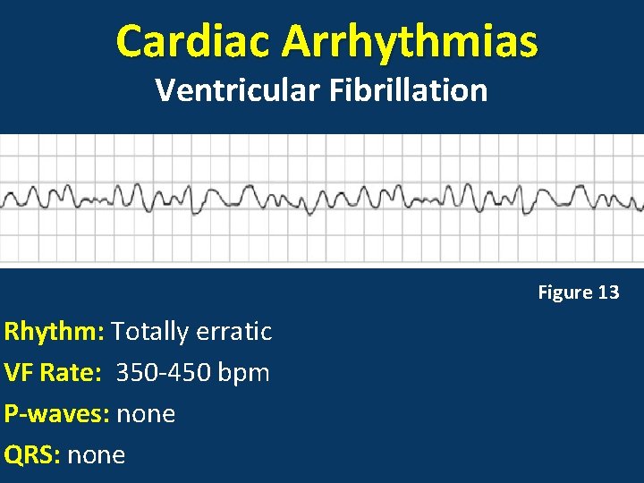 Cardiac Arrhythmias Ventricular Fibrillation Figure 13 Rhythm: Totally erratic VF Rate: 350 -450 bpm
