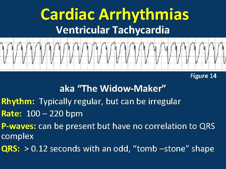 Cardiac Arrhythmias Ventricular Tachycardia Figure 14 aka “The Widow-Maker” Rhythm: Typically regular, but can