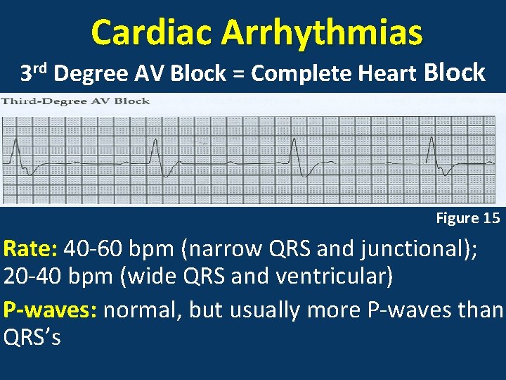 Cardiac Arrhythmias 3 rd Degree AV Block = Complete Heart Block Figure 15 Rate: