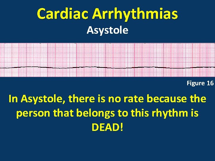 Cardiac Arrhythmias Asystole Figure 16 In Asystole, there is no rate because the person
