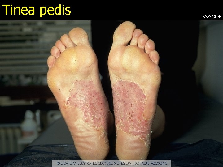 Tinea pedis www. itg. be 