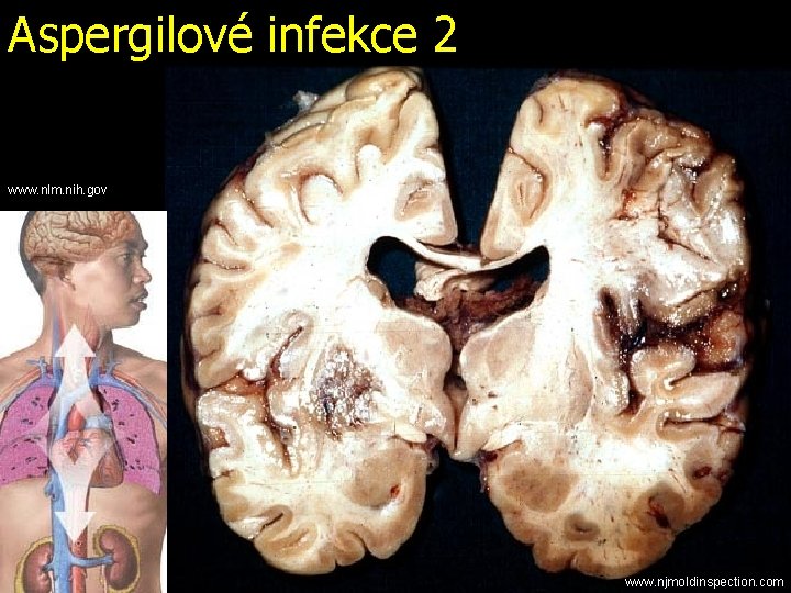 Aspergilové infekce 2 www. nlm. nih. gov www. njmoldinspection. com 