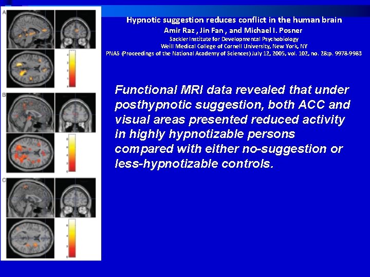 Hypnotic suggestion reduces conflict in the human brain Amir Raz , Jin Fan ,