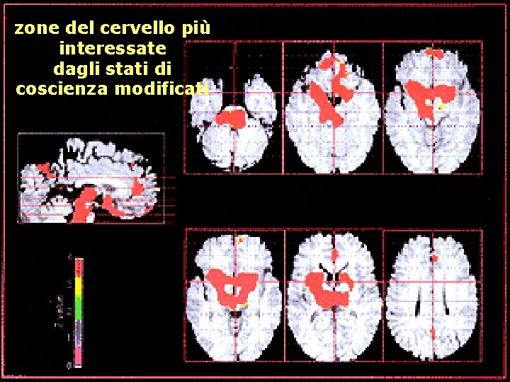 zone del cervello più interessate dagli stati di coscienza modificati 