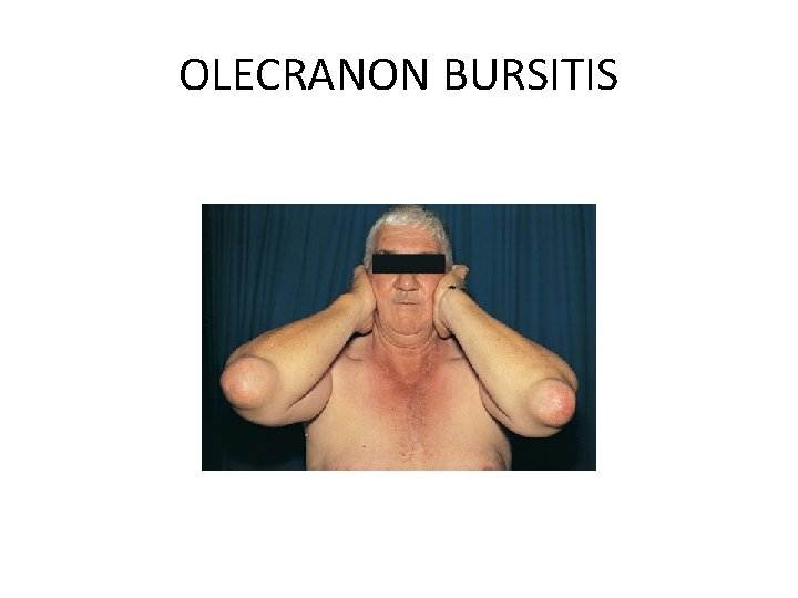 OLECRANON BURSITIS 