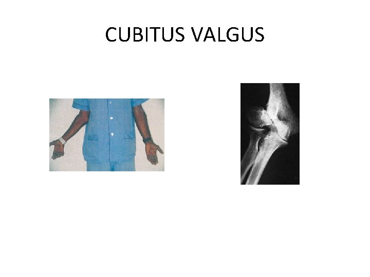 CUBITUS VALGUS 