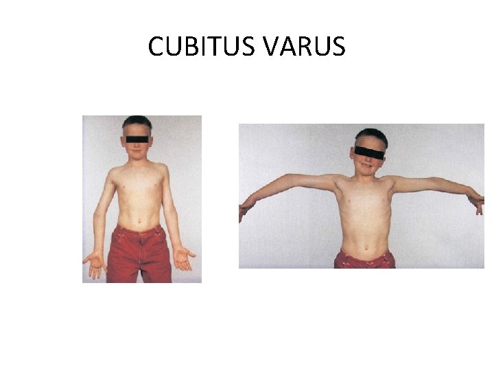 CUBITUS VARUS 