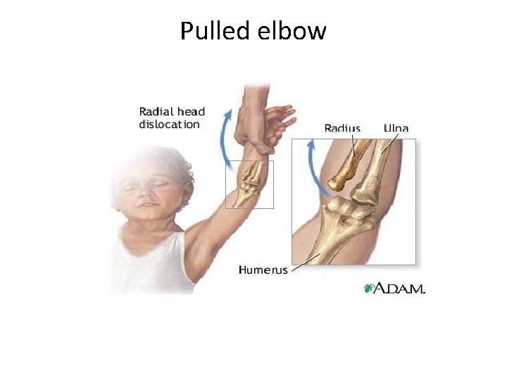 Pulled elbow 