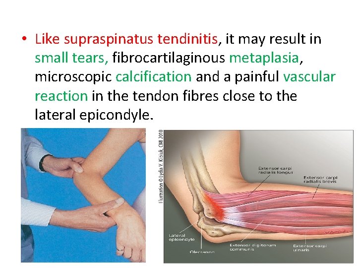  • Like supraspinatus tendinitis, it may result in small tears, fibrocartilaginous metaplasia, microscopic