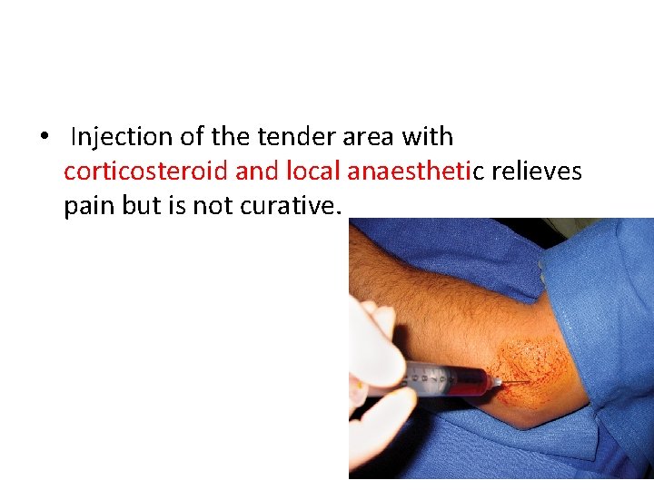  • Injection of the tender area with corticosteroid and local anaesthetic relieves pain