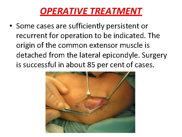 OPERATIVE TREATMENT • Some cases are sufficiently persistent or recurrent for operation to be