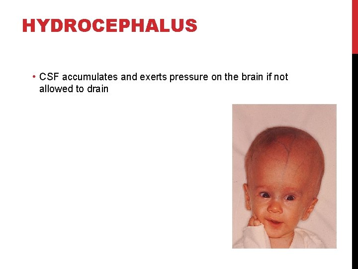 HYDROCEPHALUS • CSF accumulates and exerts pressure on the brain if not allowed to