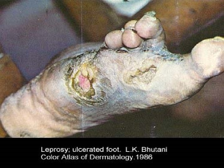 Leprosy 