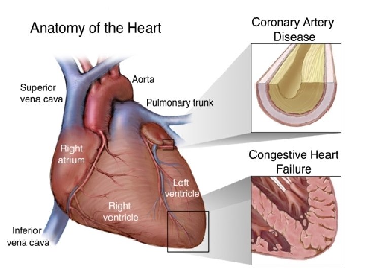 Heart disease 