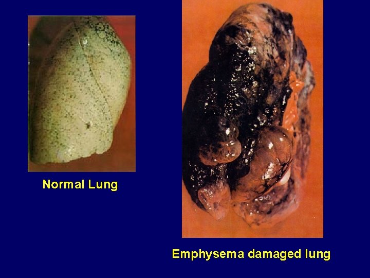 Normal Lung Emphysema damaged lung 