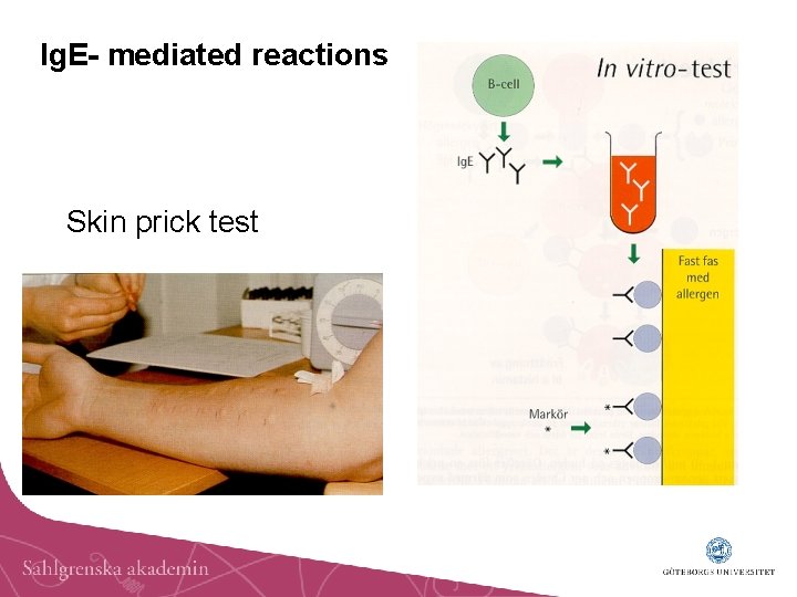 Ig. E- mediated reactions Skin prick test 