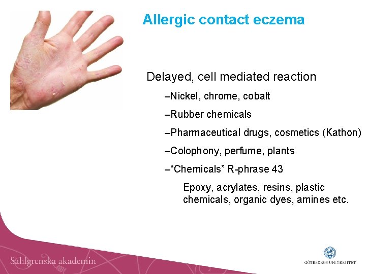 Allergic contact eczema Delayed, cell mediated reaction –Nickel, chrome, cobalt –Rubber chemicals –Pharmaceutical drugs,