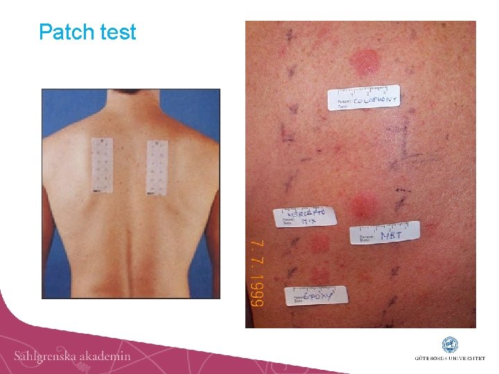 Patch test 