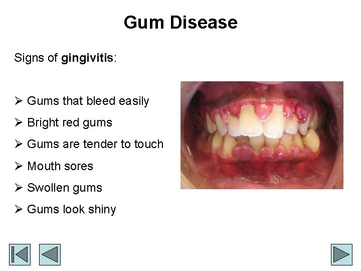 Gum Disease Signs of gingivitis: Ø Gums that bleed easily Ø Bright red gums