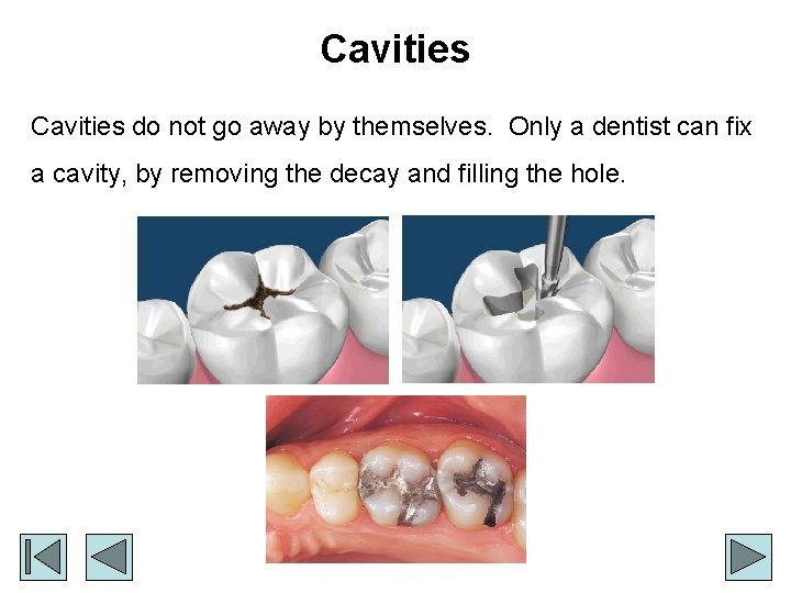 Cavities do not go away by themselves. Only a dentist can fix a cavity,
