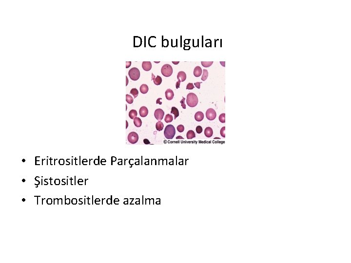 DIC bulguları • Eritrositlerde Parçalanmalar • Şistositler • Trombositlerde azalma DIC bulguları • Eritrositlerde Parçalanmalar • Şistositler • Trombositlerde azalma