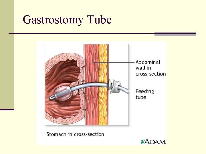 Gastrostomy Tube 