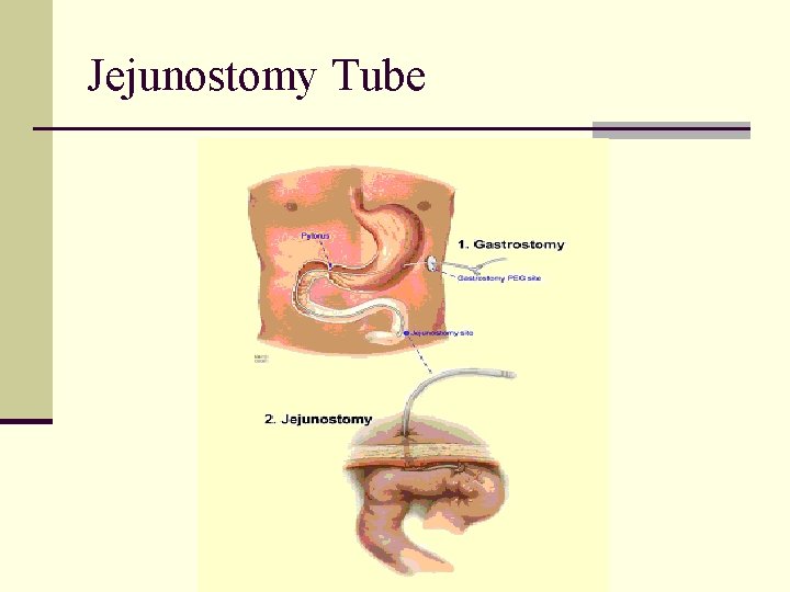 Jejunostomy Tube 