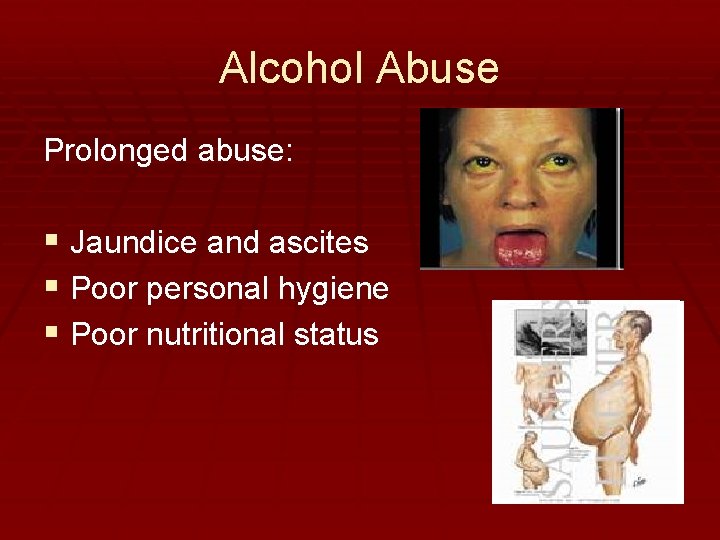 Alcohol Abuse Prolonged abuse: § Jaundice and ascites § Poor personal hygiene § Poor