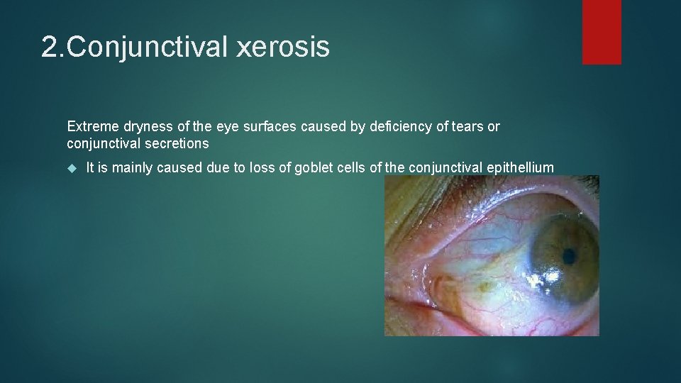 2. Conjunctival xerosis Extreme dryness of the eye surfaces caused by deficiency of tears