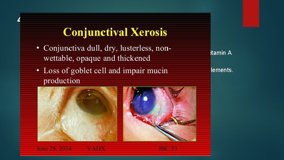 4. Corneal xerosis This is a mpre advanced stage of lesions which represent severe