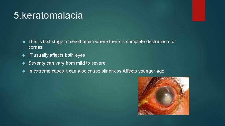 5. keratomalacia This is last stage of xerothalmia where there is complete destruction of