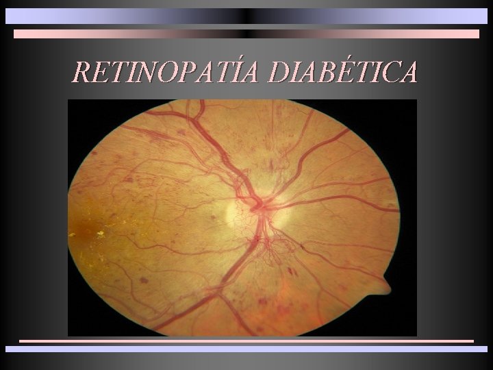 RETINOPATÍA DIABÉTICA 