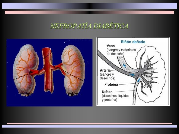 NEFROPATÍA DIABÉTICA 