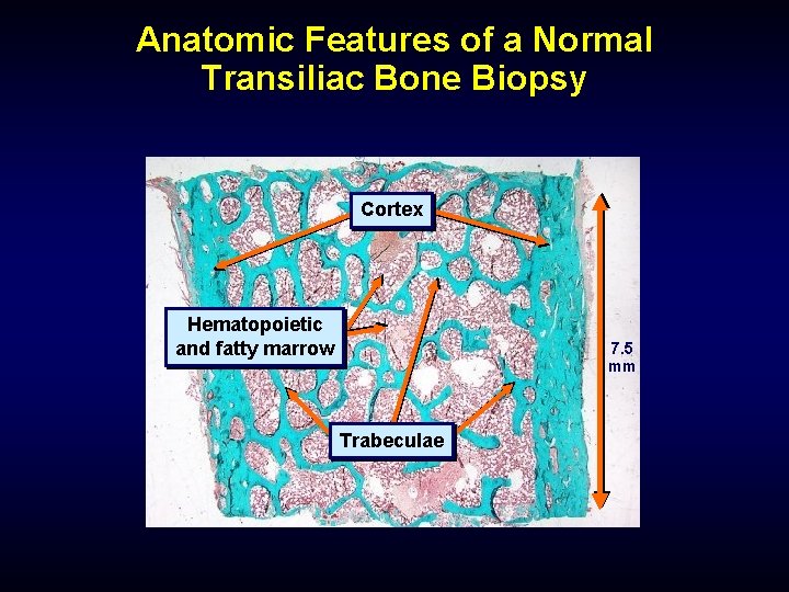 Anatomic Features of a Normal Transiliac Bone Biopsy Cortex Hematopoietic and fatty marrow 7.