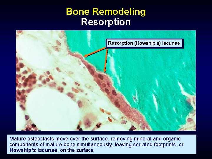 Bone Remodeling Resorption (Howship’s) lacunae Mature osteoclasts move over the surface, removing mineral and