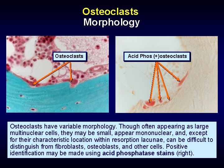 Osteoclasts Morphology Osteoclasts Acid Phos (+)osteoclasts Osteoclasts have variable morphology. Though often appearing as