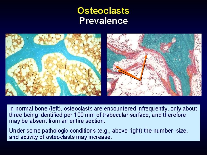 Osteoclasts Prevalence In normal bone (left), osteoclasts are encountered infrequently, only about three being