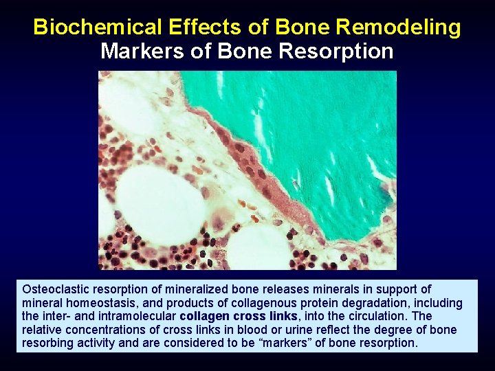 Biochemical Effects of Bone Remodeling Markers of Bone Resorption Osteoclastic resorption of mineralized bone
