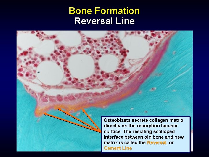 Bone Formation Reversal Line Osteoblasts secrete collagen matrix directly on the resorption lacunar surface.