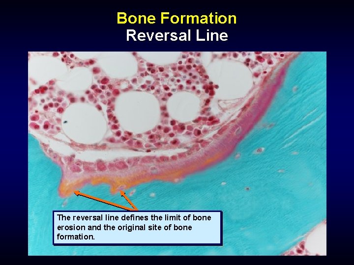 Bone Formation Reversal Line The reversal line defines the limit of bone erosion and