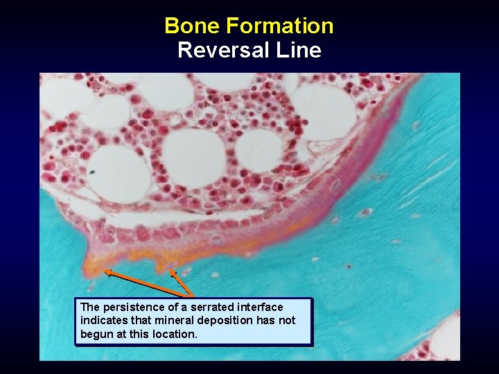 Bone Formation Reversal Line The persistence of a serrated interface indicates that mineral deposition