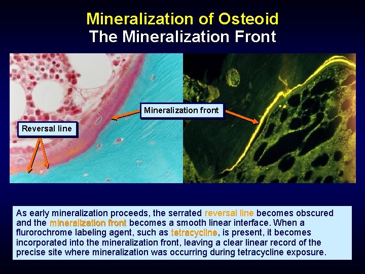 Mineralization of Osteoid The Mineralization Front Mineralization front Reversal line As early mineralization proceeds,